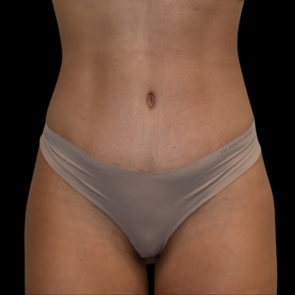 Abdominoplasty Case 9 - After