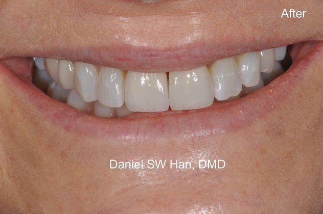 Cosmetic Dentistry Case 2 - After