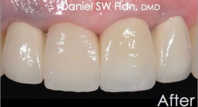Cosmetic Dentistry Case 3 - After