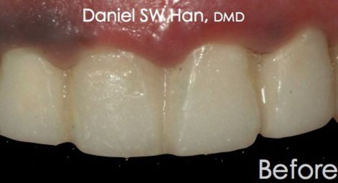 Cosmetic Dentistry Case 3 - Before
