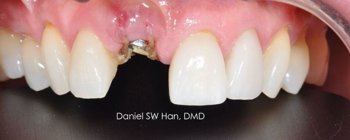 Cosmetic Dentistry: Case 4 - Before