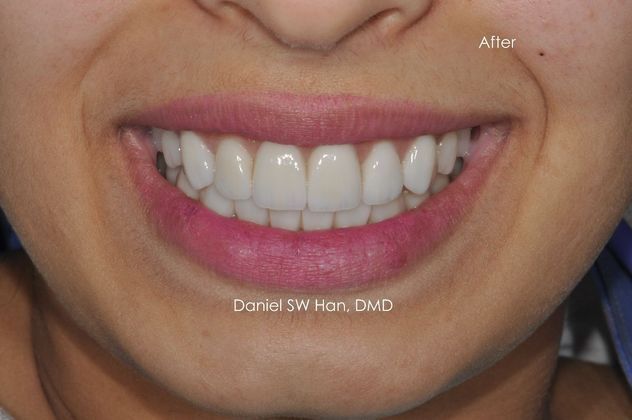 Cosmetic Dentistry Case 5 - After