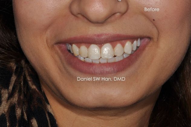 Cosmetic Dentistry Case 5 - Before