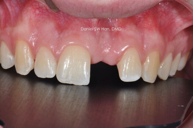 Cosmetic Dentistry: Case 6 - Before