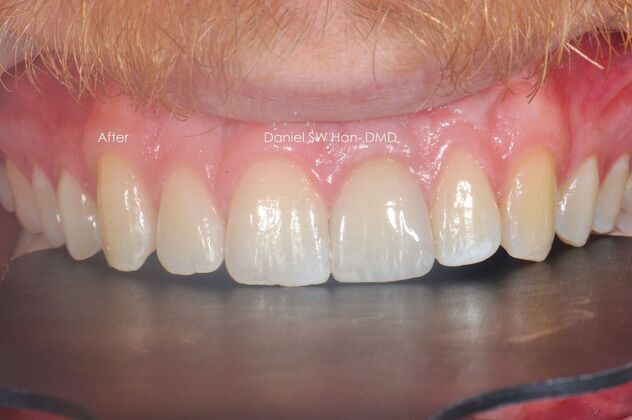 Cosmetic Dentistry: Case 6 - After