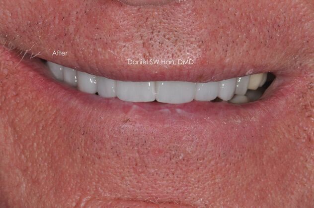 Cosmetic Dentistry: Case 7 - After