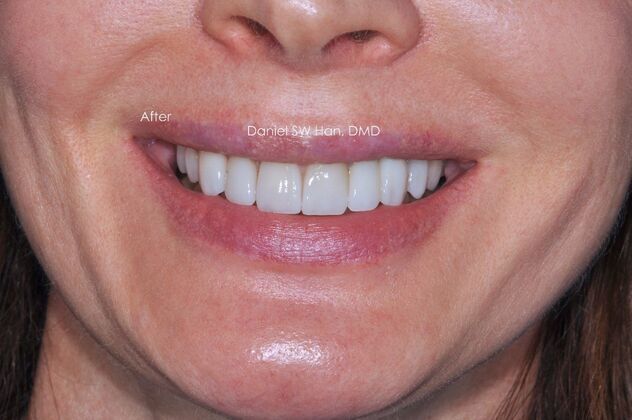 Cosmetic Dentistry Case 8 - After