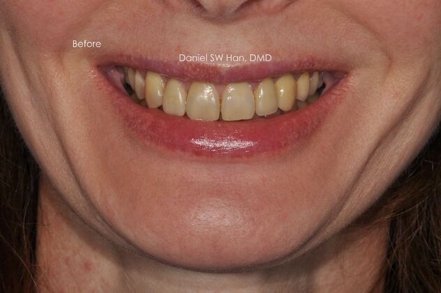 Cosmetic Dentistry Case 8 - Before