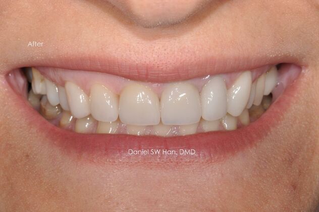 Cosmetic Dentistry: Case 11 - After