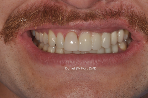 Cosmetic Dentistry Case 13 - After