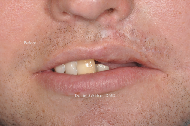 Cosmetic Dentistry Case 13 - Before