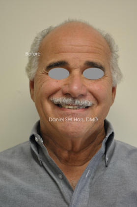 Cosmetic Dentistry: Case 14 - Before