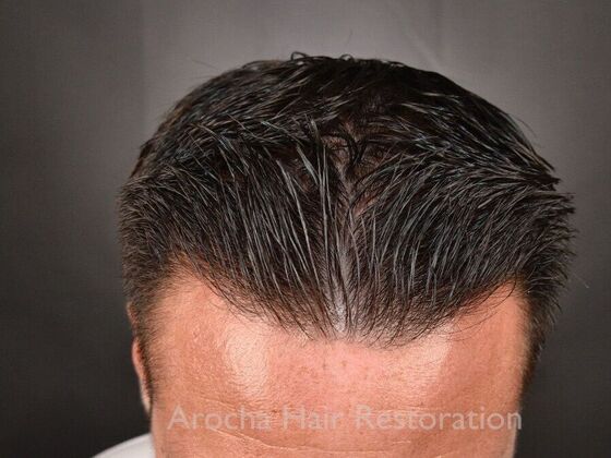 FUE Hair Restoration: Case 32 - After