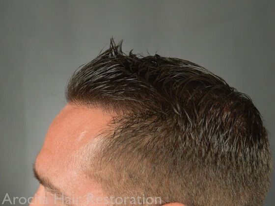 FUE Hair Restoration: Case 32 - After