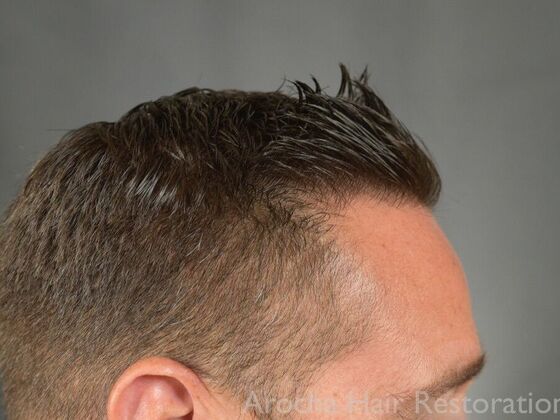 FUE Hair Restoration: Case 32 - After