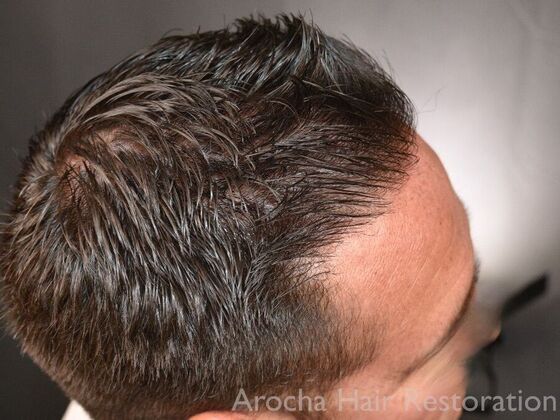 FUE Hair Restoration: Case 32 - After