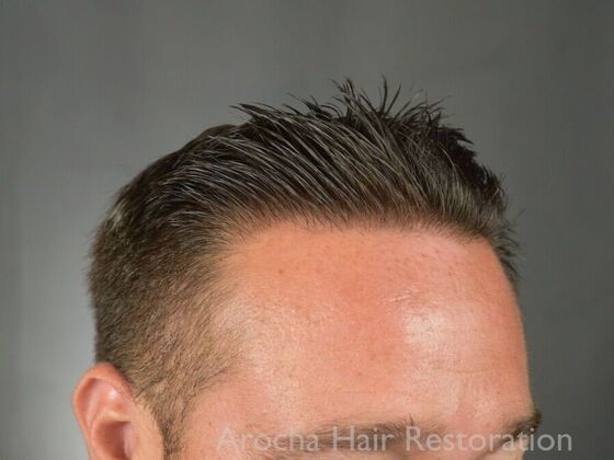 FUE Hair Restoration: Case 32 - After