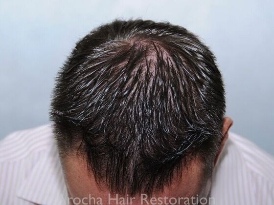 FUE Hair Restoration: Case 32 - Before