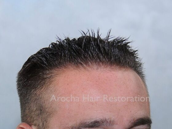 FUE Hair Restoration: Case 32 - Before