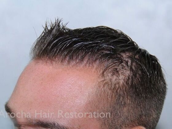 FUE Hair Restoration: Case 32 - Before
