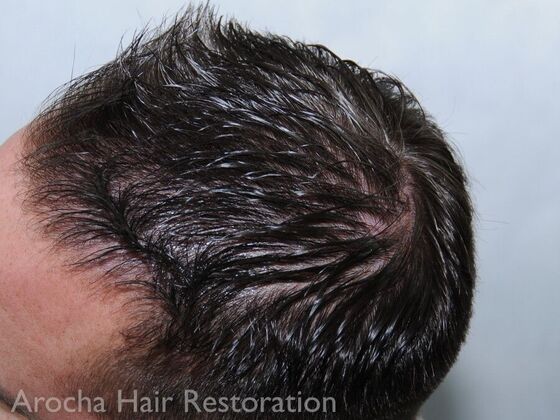 FUE Hair Restoration: Case 32 - Before
