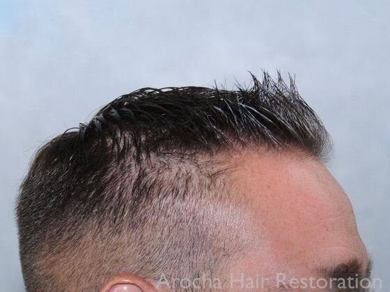 FUE Hair Restoration: Case 32 - Before