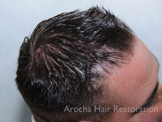 FUE Hair Restoration: Case 32 - Before