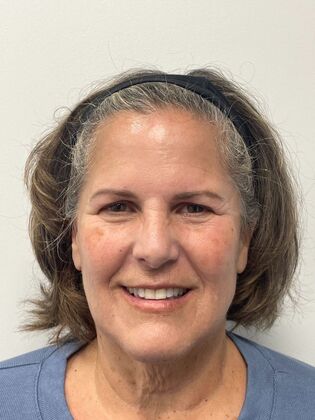 Facial Laser Rejuvenation  Case 1 - Before