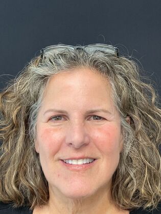 Facial Laser Rejuvenation  Case 1 - After