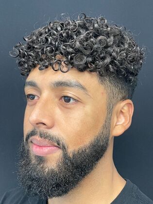 Hair Transplant  Case 1 - After