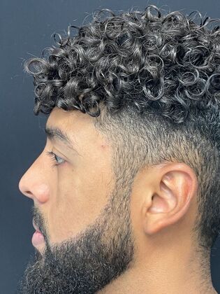 Hair Transplant : Case 1 - After