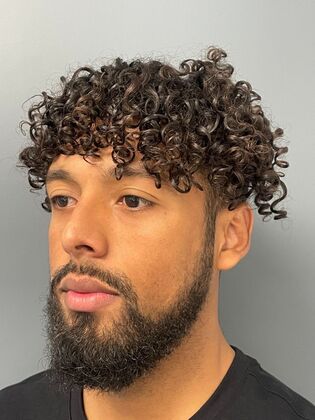 Hair Transplant  Case 1 - Before