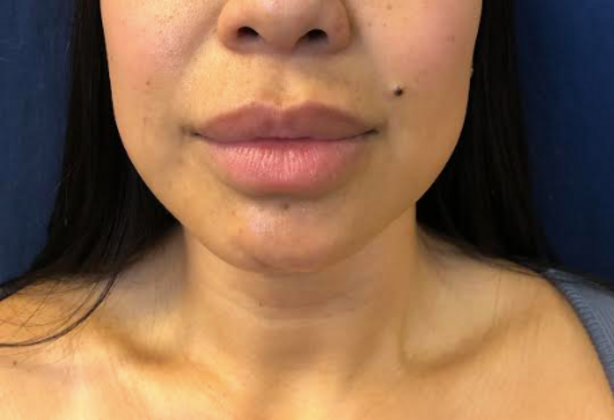 Cosmetic Injectables & Fillers*:  Case 57 Lip Filler - Before