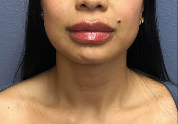 Cosmetic Injectables & Fillers*:  Case 57 Lip Filler - After