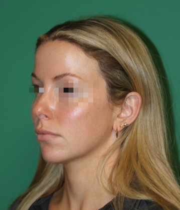 Hairline Lowering Surgery: Case 20 - After