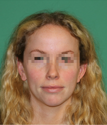 Hairline Lowering Surgery: Case 20 - Before