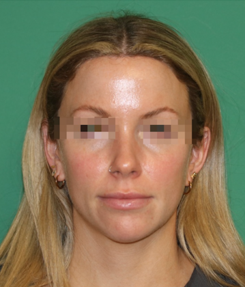 Hairline Lowering Surgery: Case 20 - After