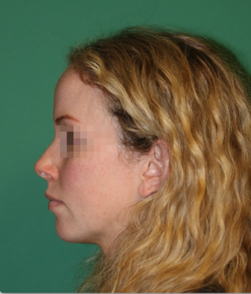 Hairline Lowering Surgery: Case 20 - Before