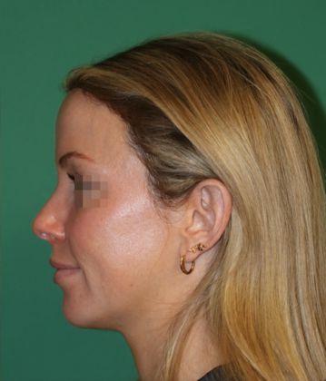 Hairline Lowering Surgery: Case 20 - After