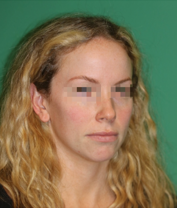 Hairline Lowering Surgery: Case 20 - Before