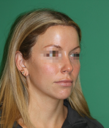 Hairline Lowering Surgery: Case 20 - After