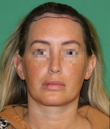 Hairline Lowering Surgery: Case 21 - Before