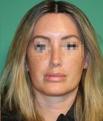 Hairline Lowering Surgery: Case 21 - After