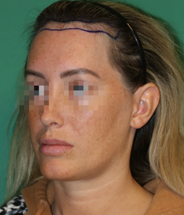 Hairline Lowering Surgery: Case 21 - Before