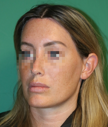 Hairline Lowering Surgery: Case 21 - After
