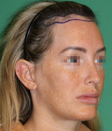 Hairline Lowering Surgery: Case 21 - Before