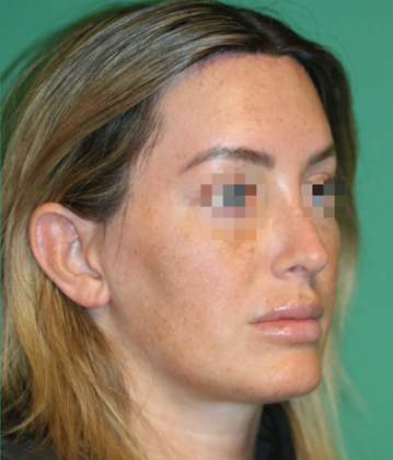 Hairline Lowering Surgery: Case 21 - After