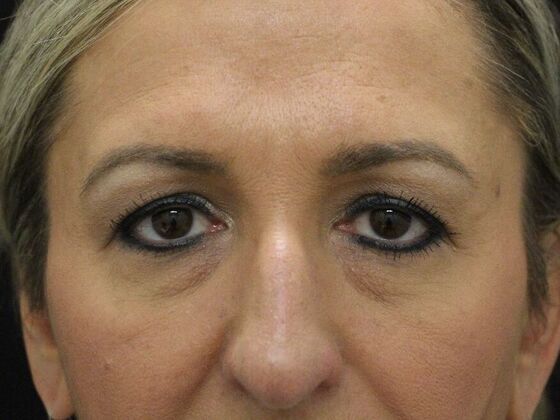 Eyelid Surgery Case 7 - Before