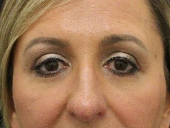 Eyelid Surgery Case 7 - After