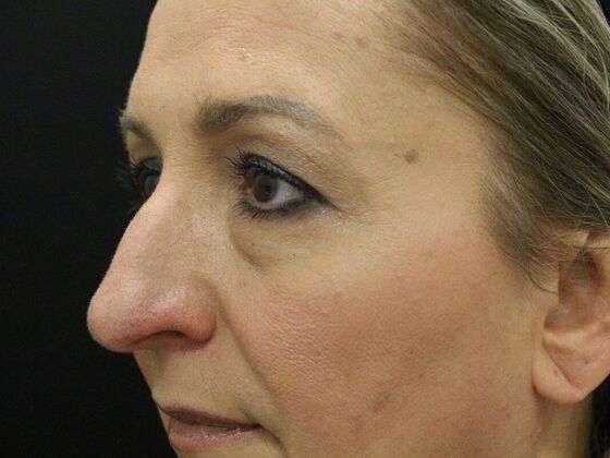 Eyelid Surgery: Case 7 - Before